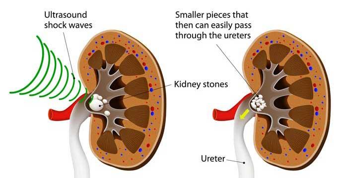 Extracorporeal Shock Wave Lithotripsy (ESWL)